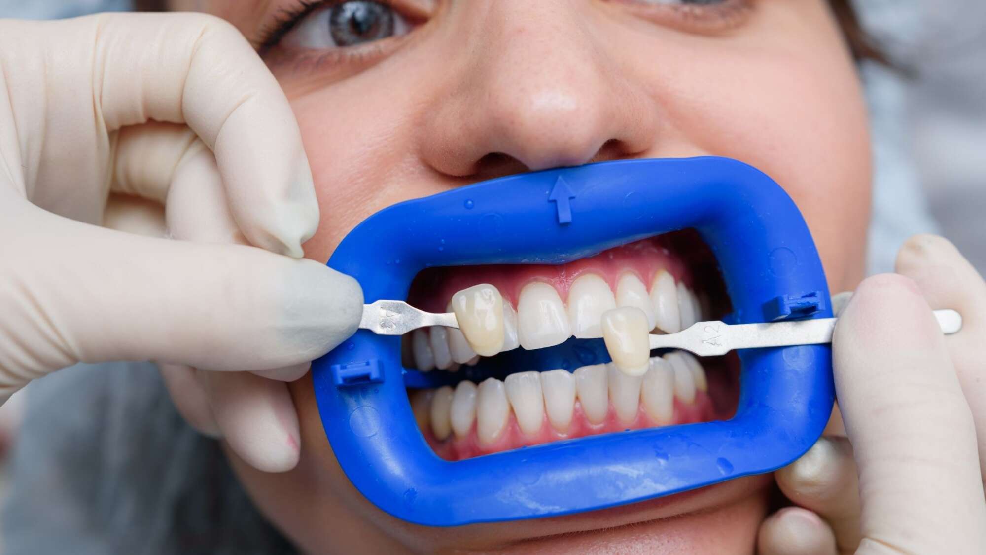 What Are Dental Veneers Everything You Need To Know Swedish Dental